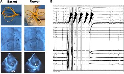 Initial experience with pulsed field ablation for atrial fibrillation